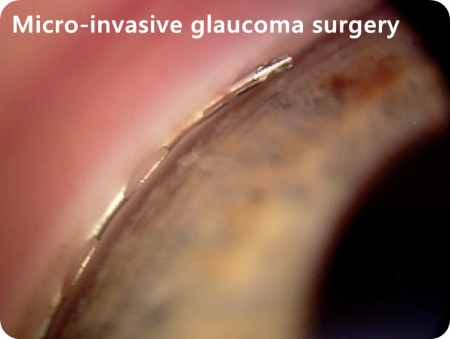 Micro-invasive glaucoma surgery