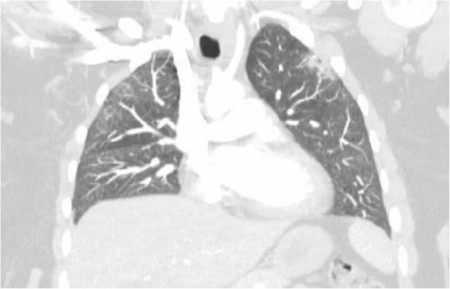 Report of the month_Pericardial effusion