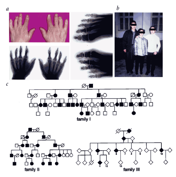 Mutations in <i>IHH</i>, encoding Indian hedgehog, cause brachydactyly type A-1