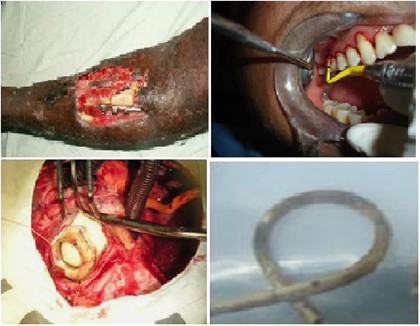 Characteristics of bacterial biofilm associated with implant material in clinical practice