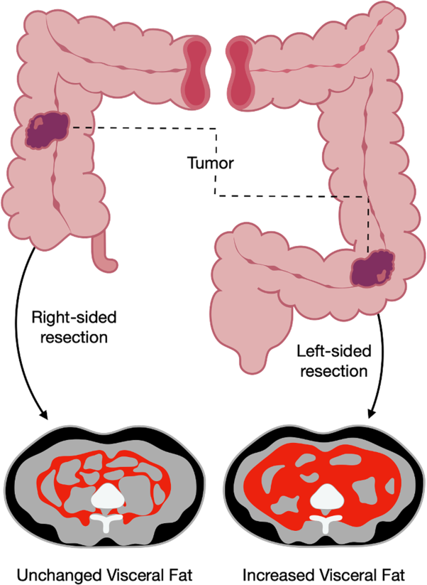 Change in abdominal obesity after colon cancer surgery – effects of left-sided and right-sided colonic resection