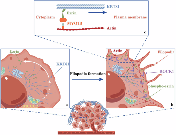 KRT81 promotes metastasis of colorectal cancer by acting as a protein scaffold for ezrin