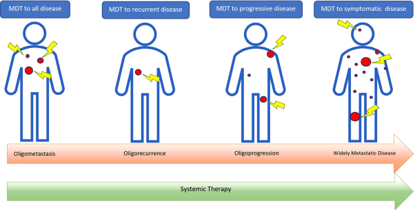 Metastasis-directed therapy for oligometastasis and beyond