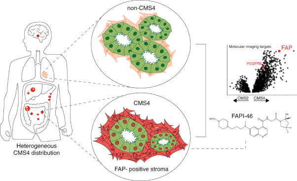 Fibroblast activation protein identifies Consensus Molecular Subtype 4 in colorectal cancer and allows its detection by <sup>68</sup>Ga-FAPI-PET imaging