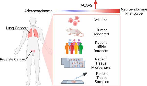 ACAA2 is a novel molecular indicator for cancers with neuroendocrine phenotype