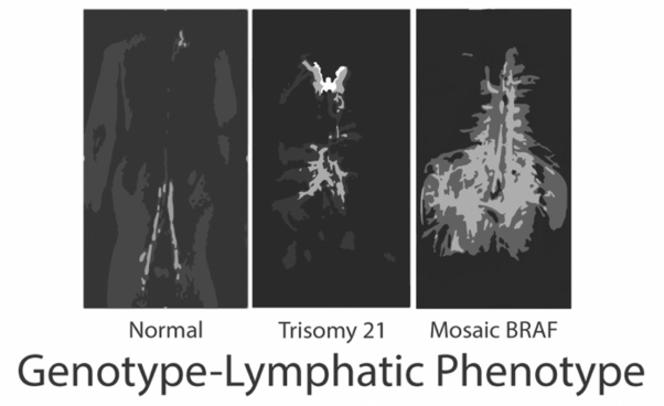 Genetics etiologies and genotype phenotype correlations in a cohort of individuals with central conducting lymphatic anomaly