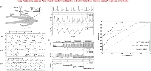 Using noninvasive adjusted pulse transit time for tracking beat-to-beat systolic blood pressure during ventricular arrhythmia