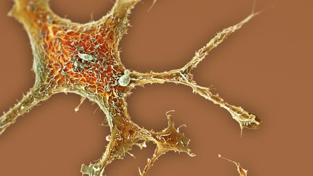 Cancer cells