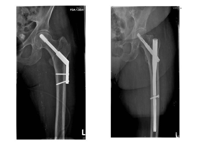 Gute Lösungen für Frakturen