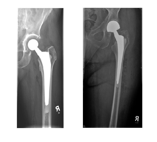 Totalendoprothese mit einem zementierten Langschaf