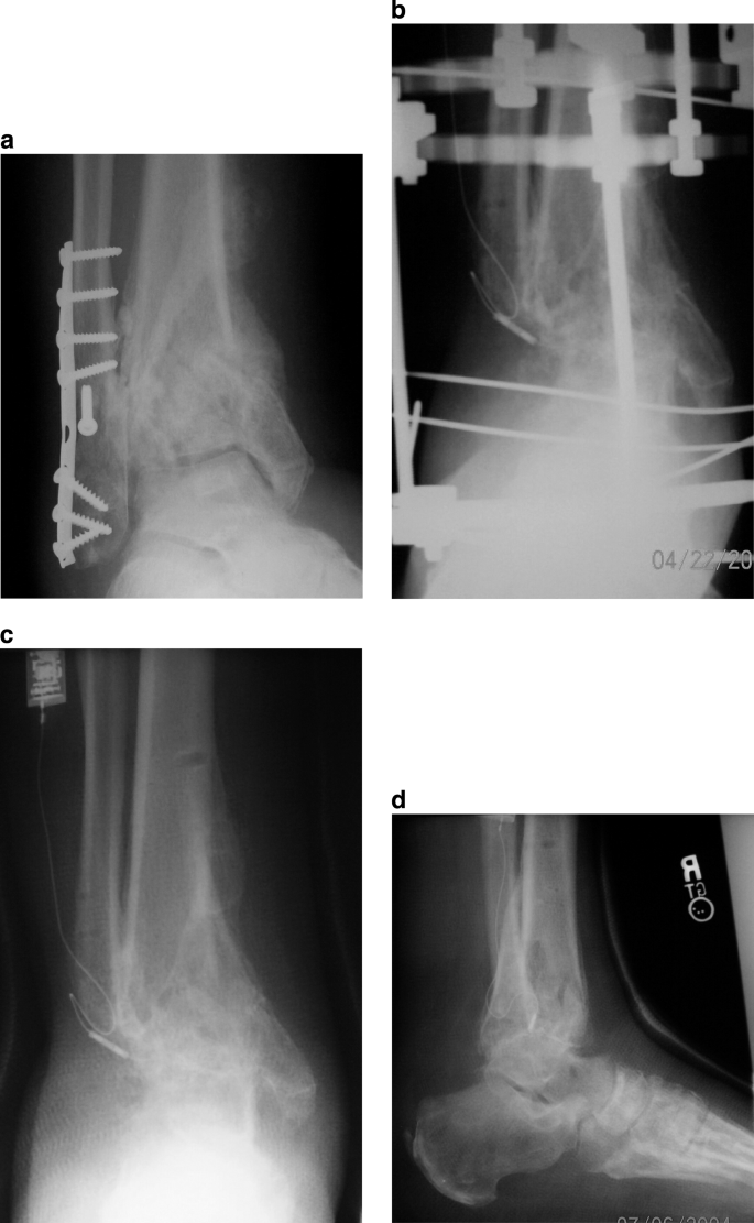 Posttraumatic Reconstruction of the Ankle Using the Ilizarov