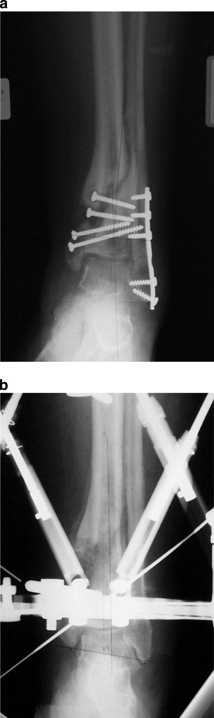 Posttraumatic Reconstruction of the Ankle Using the Ilizarov