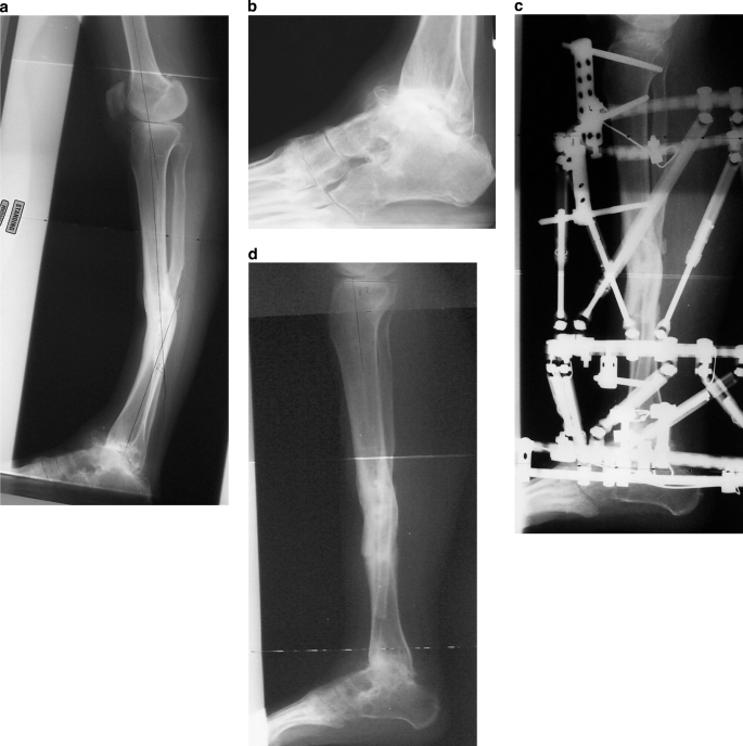 Posttraumatic Reconstruction of the Ankle Using the Ilizarov