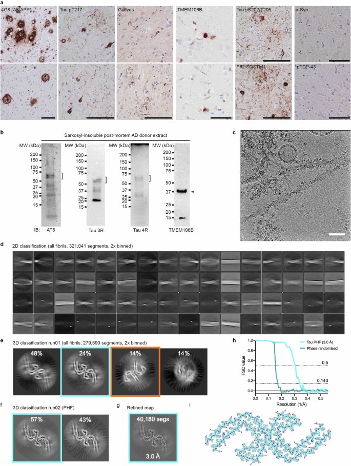 CryoET of β-amyloid and tau within postmortem Alzheimer’s disease brain ...