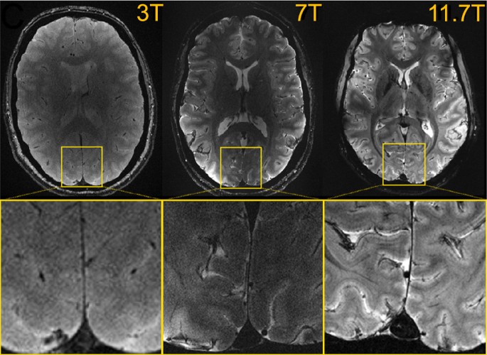 In vivo imaging of the human brain with the Iseult 11.7T MRI scanner