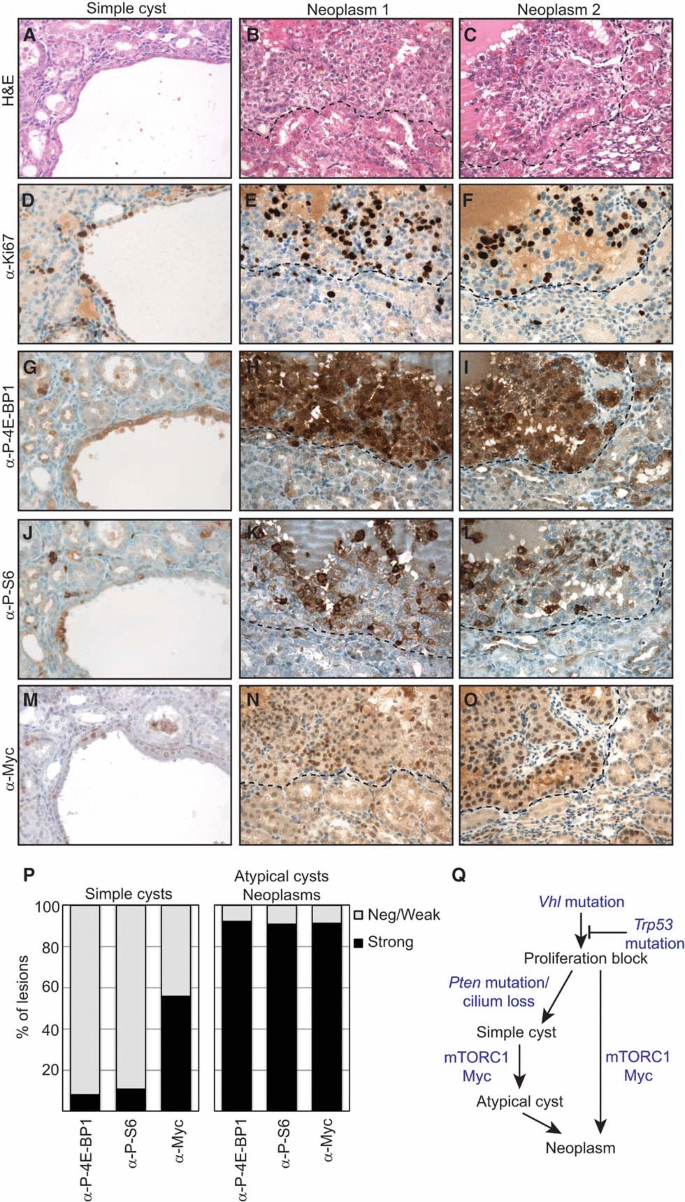 Combined mutation of Vhl and Trp53 causes renal cysts and tumours in ...