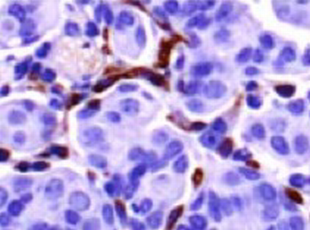 Contrasting responses of non‐small cell lung cancer to antiangiogenic ...