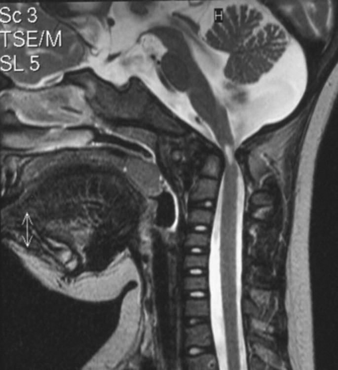Orthopedische Afwijkingen Bij Het Syndroom Van Down Springerlink