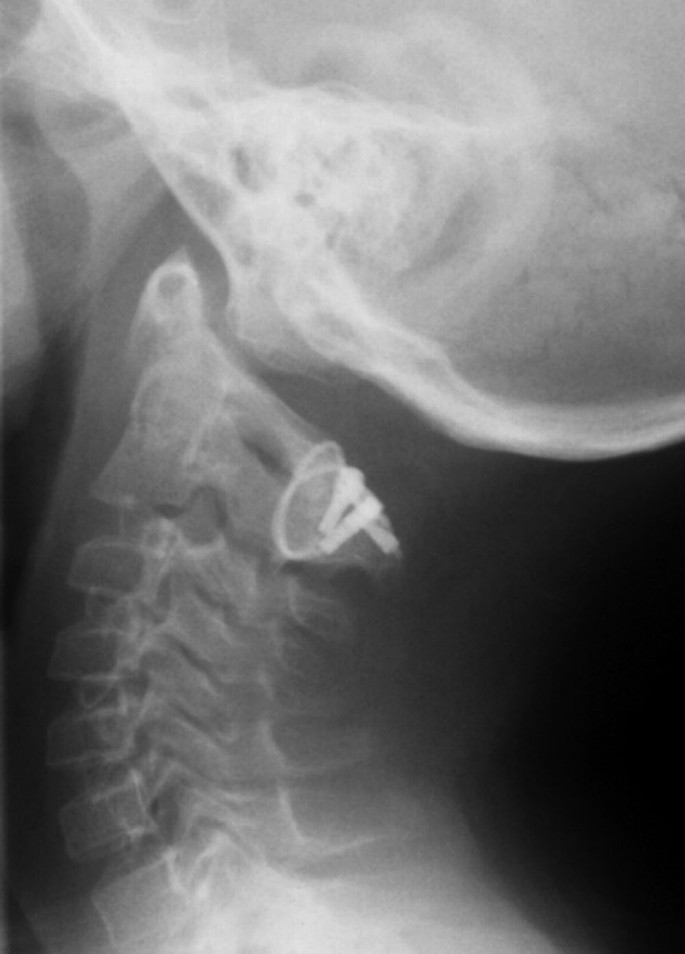 Orthopedische Afwijkingen Bij Het Syndroom Van Down Springerlink