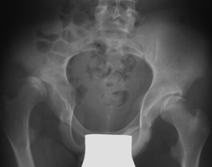 Orthopedische Afwijkingen Bij Het Syndroom Van Down Springerlink