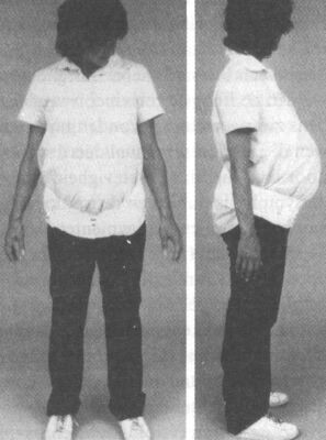 Gevolgen Van Zwangerschap Voor Het Bewegingsapparaat Springerlink