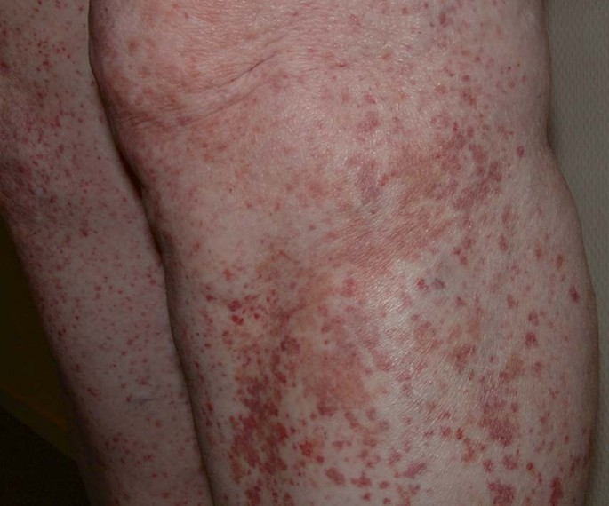 Vlekjes Met Koorts Springerlink