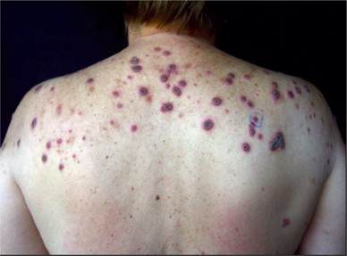 Primary Biliary Cholangitis Associated with Skin Disorders-Dr-Qaisar-Ahmed