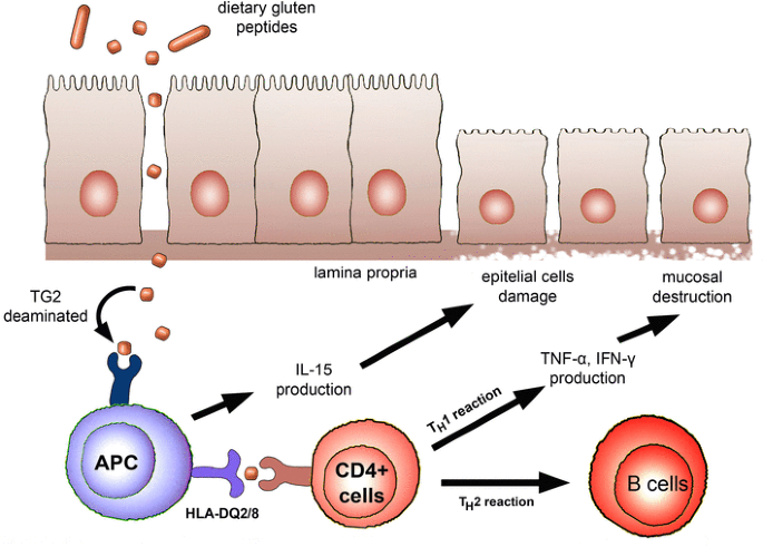 autoimmune disease and gluten free diet