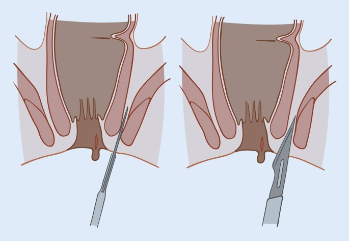 Lateral internal sphincterotomy (LIS)—still top gun in chronic anal fissure  treatment? | SpringerLink