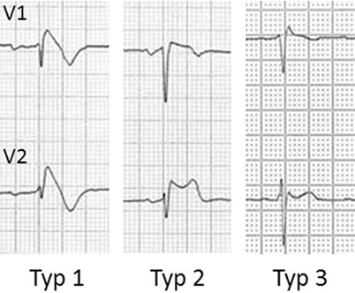 Ekg Diagnostik Bei Leistungssportlern Springerlink