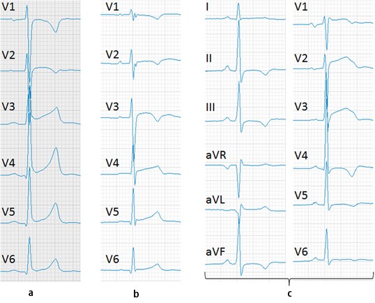 Ekg Diagnostik Bei Leistungssportlern Springerlink