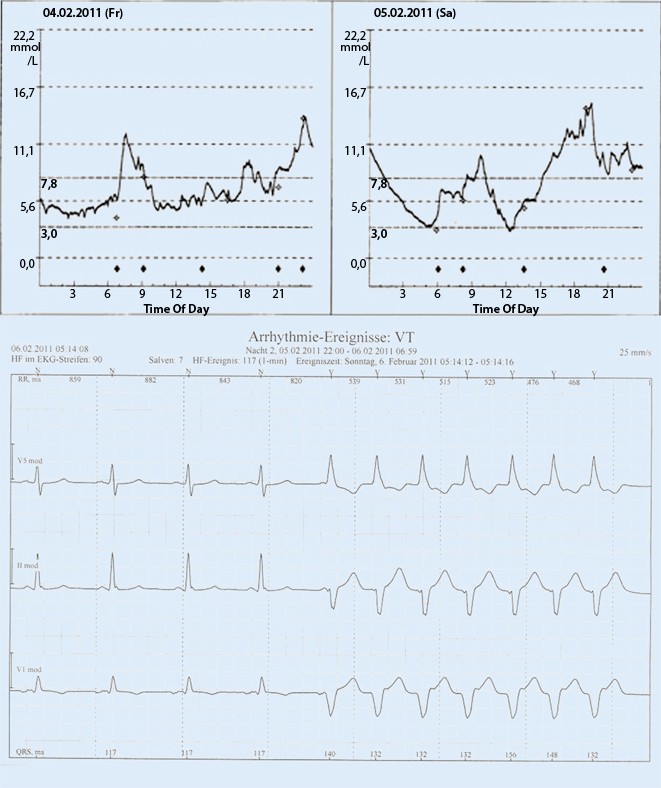 Hypoglykamie Und Herzrhythmusstorungen Bei Patienten Mit Diabetes Typ 2 Springerlink