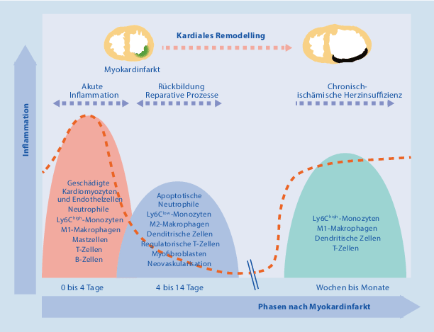 Kardiales Remodelling Nach Myokardinfarkt Springerlink