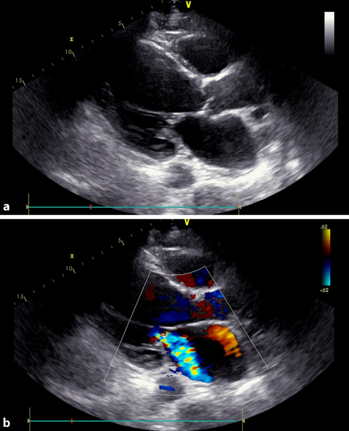 Echocardiographic Assessment In Cardiogenic Shock Springerlink