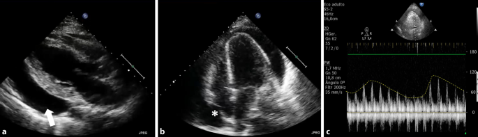 Echocardiographic Assessment In Cardiogenic Shock Springerlink