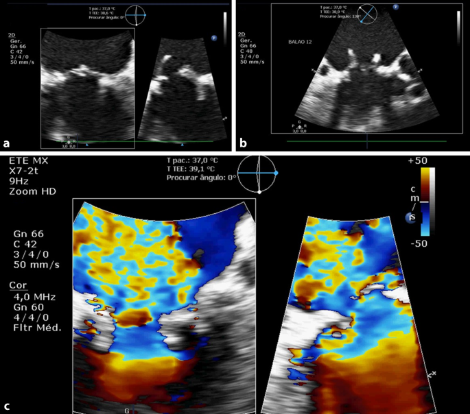 Echocardiographic Assessment In Cardiogenic Shock Springerlink