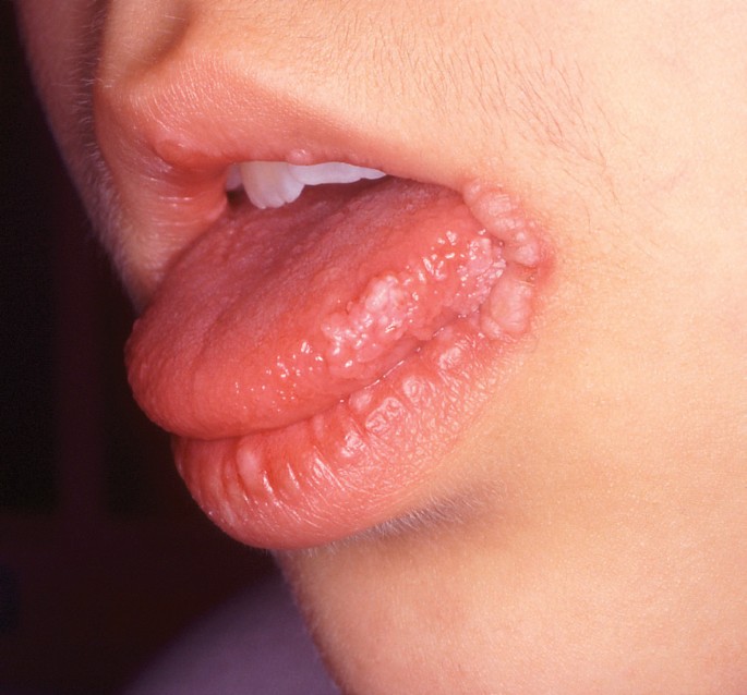 Papillomavírus zunge,