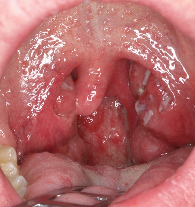 Die Tonsillitis im Kindes- und Erwachsenenalter | SpringerLink