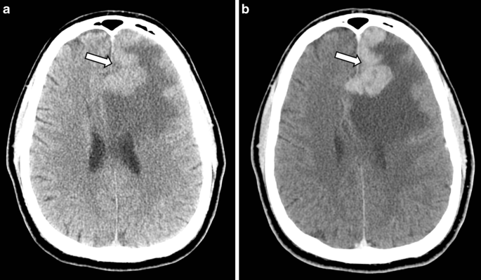 Primary Cns Lymphoma Presenting As Enhancing Cortical Ribboning And Hemorrhage Springerlink