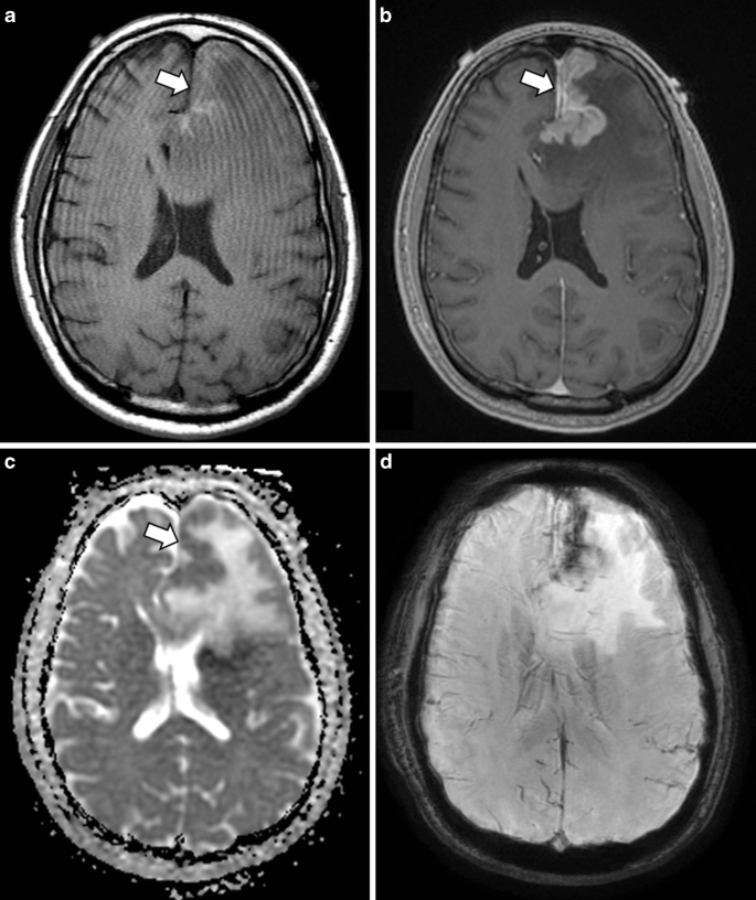 Cns Lymphoma Radiology Key