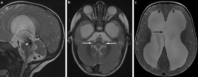 Blakeʼs Pouch Cysts and Differential Diagnoses in Prenatal and Postnatal  MRI | SpringerLink