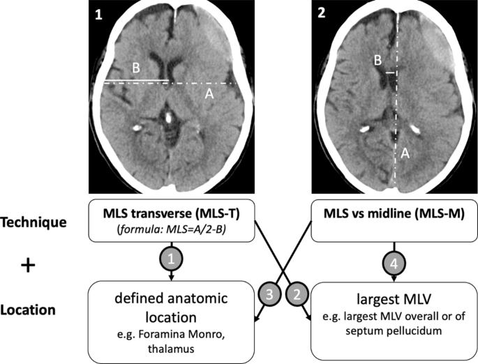 Radiological Evaluation Criteria for Chronic Subdural Hematomas 