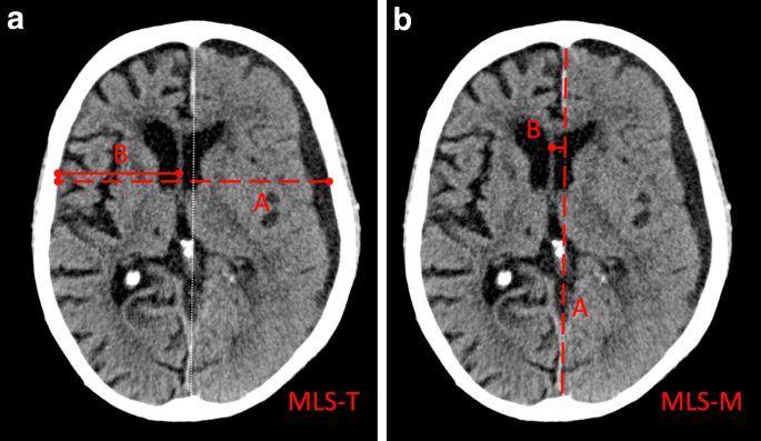 Midline Shift in Chronic Subdural Hematoma | Clinical Neuroradiology