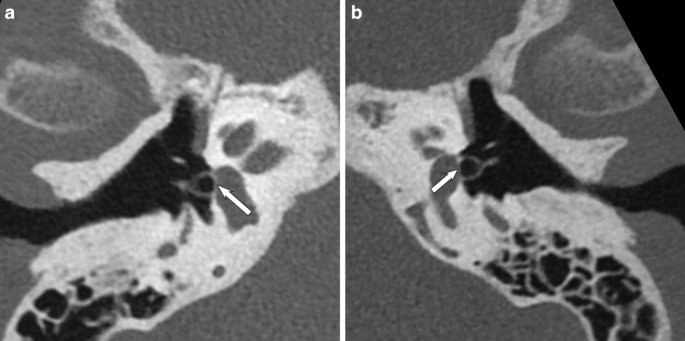 pyramidal eminence ct