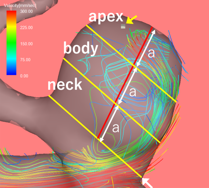 Characterization of Maximum Wall Shear Stress Points in Unruptured ...