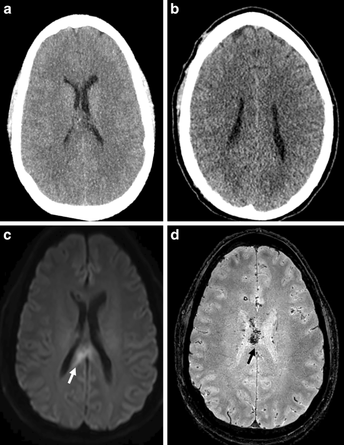 Evaluation of CT and MRI Radiomics for an Early Assessment of Diffuse ...