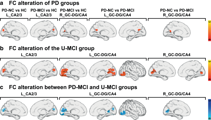 Hippocampal Subfield Vulnerability and Functional Connectivity in ...