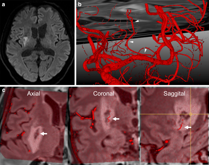Perforator Infarction Visualization of Culprit Perforating Artery in Subcortical Infarction ...