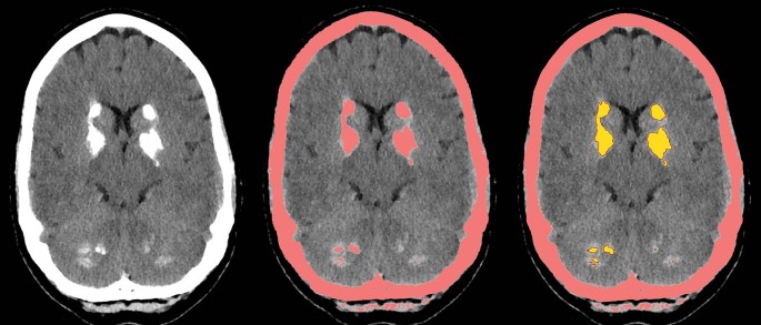 Stone Brain CT-based Volume Measurement of Brain Calcification Is Related to ...