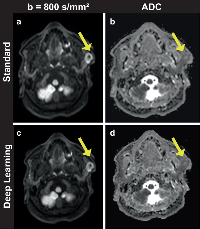 Deep Learning Reconstruction of Diffusion-weighted MRI Enables Shorter ...